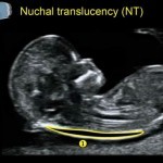 NT Screening Nackenfaltentransparenzmessung