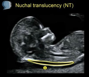 NT Screening Nackenfaltentransparenzmessung