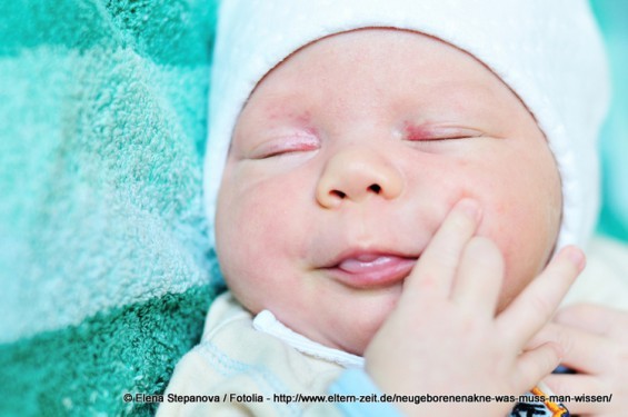 Neugeborenenakne, Babyakne oder 'acne neonatorum' - Fast jedes 5. Kind leidet darunter (© Elena Stepanova / Fotolia)