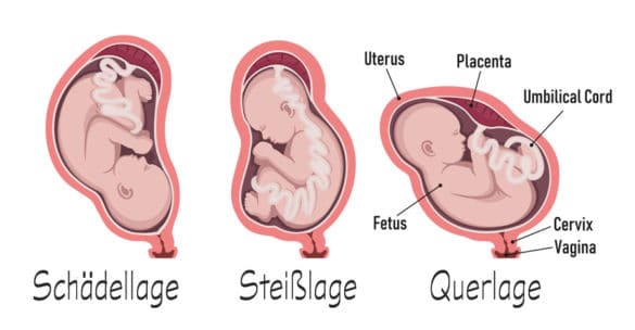 Schädellage bei Babys: Welche Bedeutung hat sie für die Schwangerschaft ...